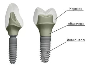 Абатменты для имплантов
