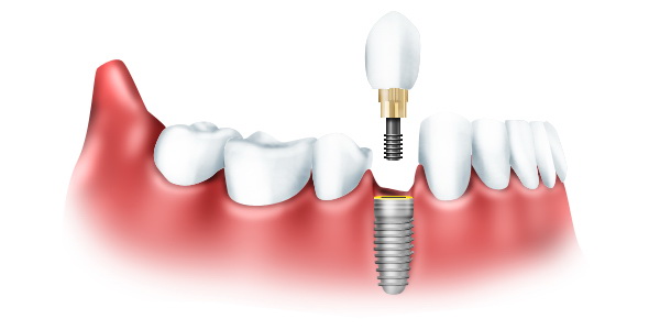 Возможности имплантации зубов