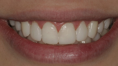 Готовые керамические виниры, зафиксированные на зубах