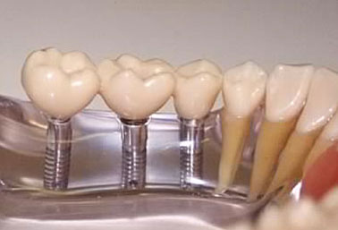 Пртезирование на имплантах - наиболее <br/>дорогостоящий вид восстановления зубов