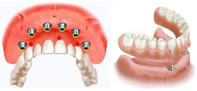 Условно-съемные зубные протезы