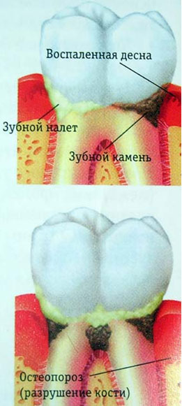Заболевания пародонта: гингивит, пародонтит, пародонтоз