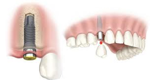 Дентальная имплантация, восстановление утраченного зуба