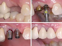 Современные технологии имплантации зубов