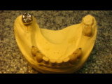 Комплексное протезирование зубов при помощи бюгельного протеза и металлокерамики