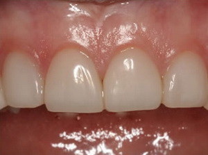 Зубы после реставрации керамическими винирами