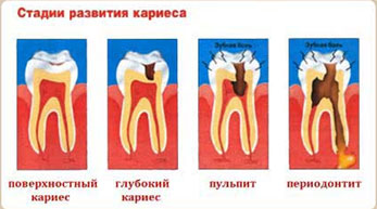 Стадии кариеса